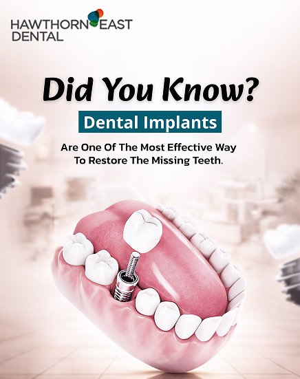 dental implants